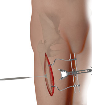 Complex Hip Reconstruction Surgery