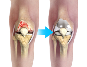 Complex Total Knee Replacement