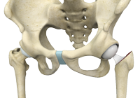 Hip Hemiarthroplasty