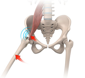 Iliopsoas Impingement