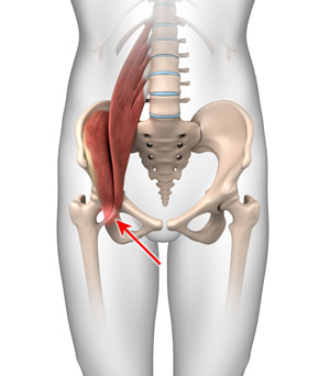 Iliopsoas Tendonitis