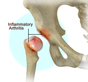 Inflammatory Arthritis