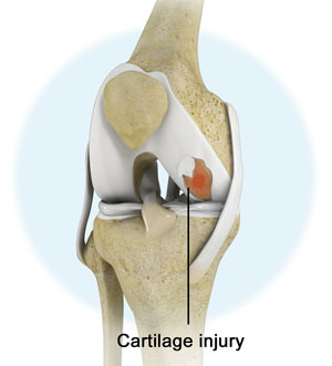 Knee Injury