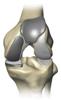 Mako Robotic-Arm Assisted Technology for partial knee replacement