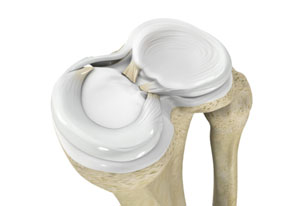 Meniscal Injuries