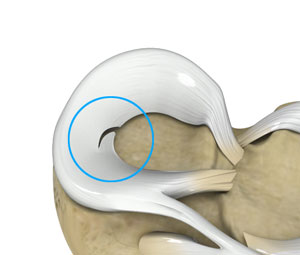 Meniscal Tears