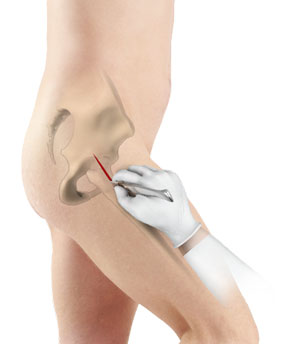 Correction of a Painful Hip Replacement