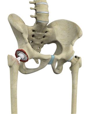 Revision Hip Replacement