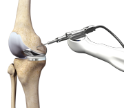 Robotic Unicondylar Knee Replacement