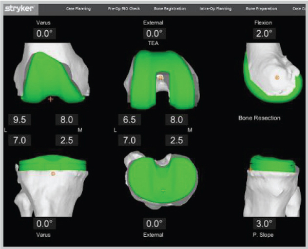 Knee Personalized Planning