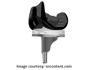 Total knee replacement with OXINIUM◊ Technology