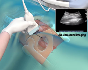 Ultrasound Guided Hip Injections