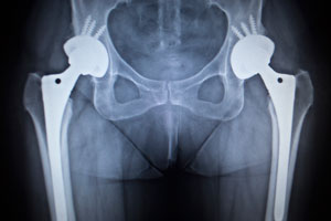 X-ray Guided Hip Replacement