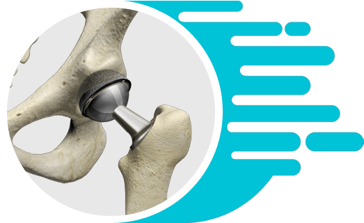 Total Hip Replacement