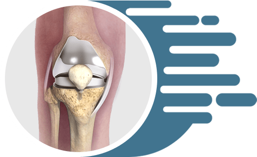 Total Knee Replacement